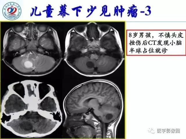 【PPT】儿童幕下脑肿瘤的诊断思路和功能MRI的规范使用