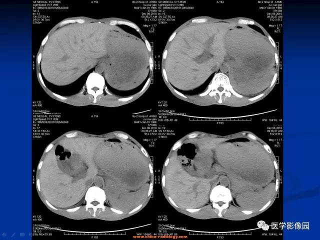 【病例】十二指肠球部腺癌1例CT影像表现 【病例】十二指肠球部腺癌1例CT影像表现