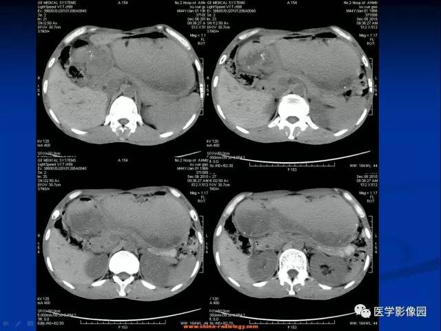 【病例】十二指肠球部腺癌1例CT影像表现 【病例】十二指肠球部腺癌1例CT影像表现