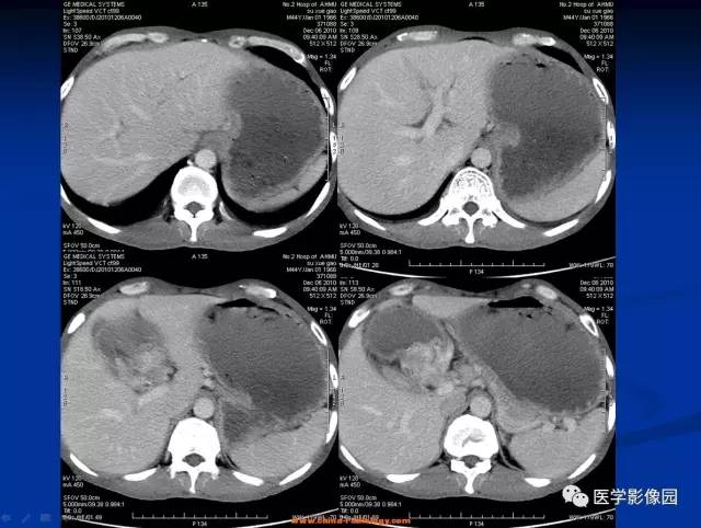 【病例】十二指肠球部腺癌1例CT影像表现 【病例】十二指肠球部腺癌1例CT影像表现