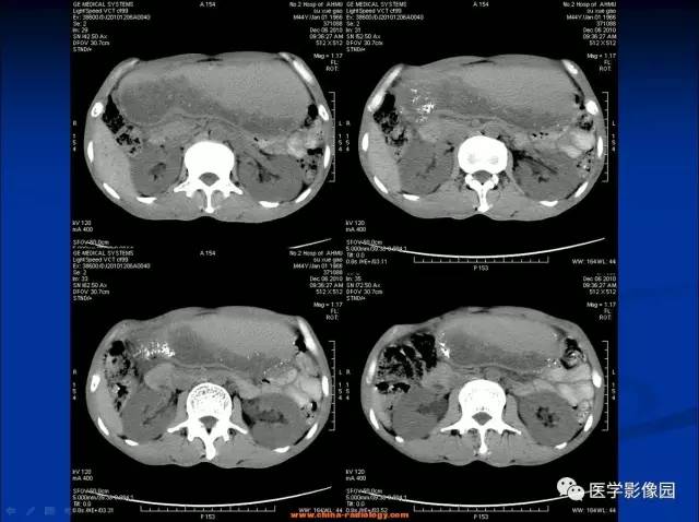 【病例】十二指肠球部腺癌1例CT影像表现 【病例】十二指肠球部腺癌1例CT影像表现