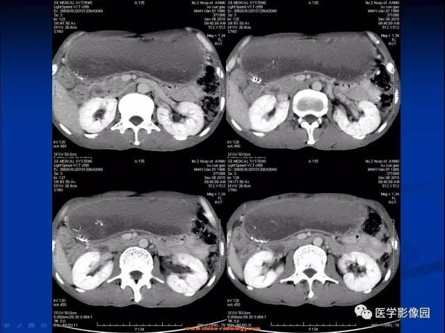 【病例】十二指肠球部腺癌1例CT影像表现 【病例】十二指肠球部腺癌1例CT影像表现
