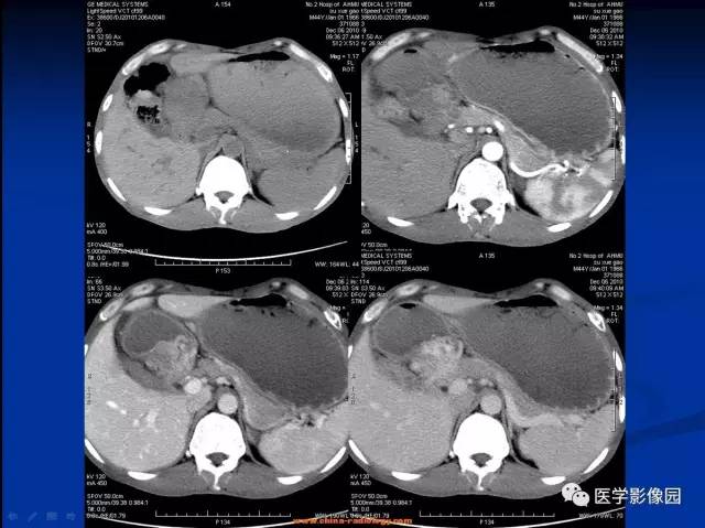 【病例】十二指肠球部腺癌1例CT影像表现 【病例】十二指肠球部腺癌1例CT影像表现