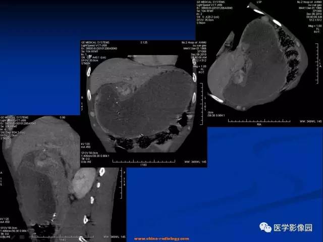 【病例】十二指肠球部腺癌1例CT影像表现 【病例】十二指肠球部腺癌1例CT影像表现