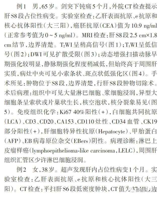 【病例】肝脏淋巴上皮瘤样癌三例