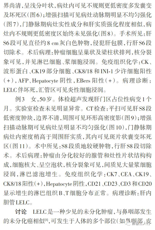 【病例】肝脏淋巴上皮瘤样癌三例