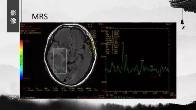 【病例】胶质母细胞瘤1例MR影像表现