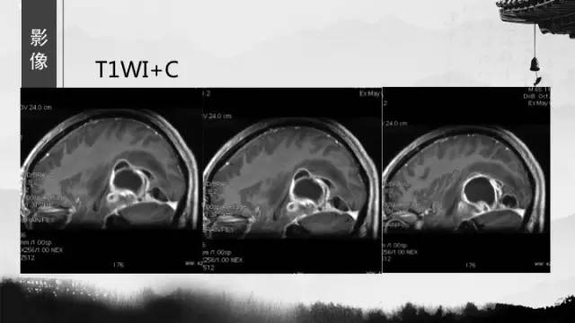 【病例】胶质母细胞瘤1例MR影像表现