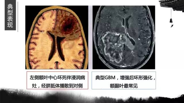 【病例】胶质母细胞瘤1例MR影像表现