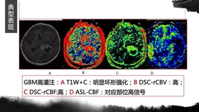 【病例】胶质母细胞瘤1例MR影像表现