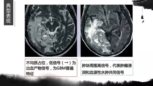 【病例】胶质母细胞瘤1例MR影像表现