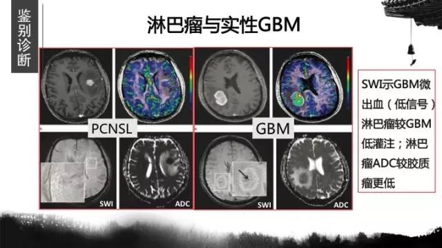 【病例】胶质母细胞瘤1例MR影像表现