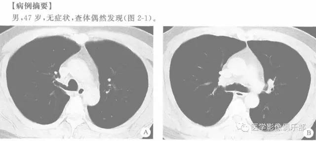 【病例】气管性支气管1例CT
