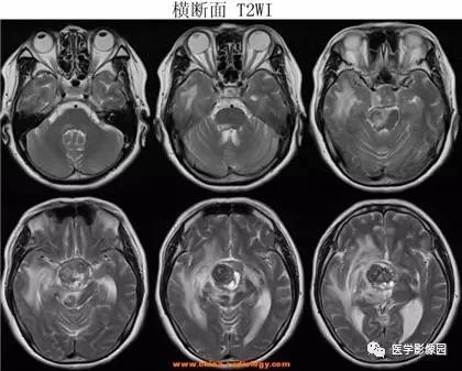 【病例】鞍区颗粒细胞瘤1例CT及MR影像表现 【病例】鞍区颗粒细胞瘤1例CT及MR影像表现