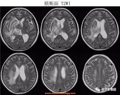 【病例】鞍区颗粒细胞瘤1例CT及MR影像表现 【病例】鞍区颗粒细胞瘤1例CT及MR影像表现