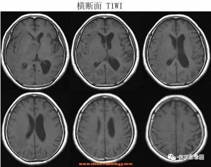 【病例】鞍区颗粒细胞瘤1例CT及MR影像表现 【病例】鞍区颗粒细胞瘤1例CT及MR影像表现