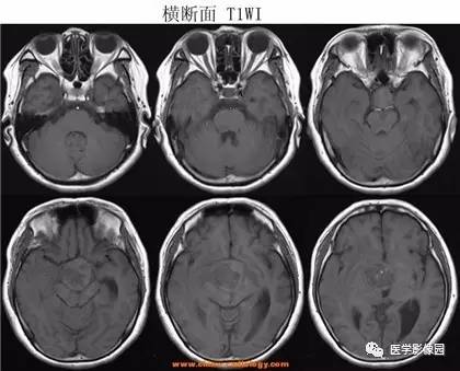 【病例】鞍区颗粒细胞瘤1例CT及MR影像表现 【病例】鞍区颗粒细胞瘤1例CT及MR影像表现