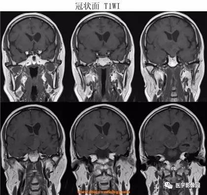 【病例】鞍区颗粒细胞瘤1例CT及MR影像表现 【病例】鞍区颗粒细胞瘤1例CT及MR影像表现