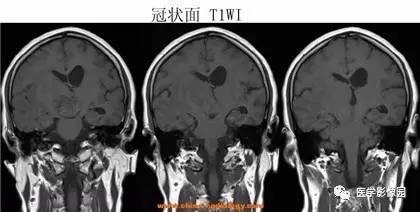 【病例】鞍区颗粒细胞瘤1例CT及MR影像表现 【病例】鞍区颗粒细胞瘤1例CT及MR影像表现