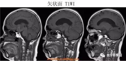 【病例】鞍区颗粒细胞瘤1例CT及MR影像表现 【病例】鞍区颗粒细胞瘤1例CT及MR影像表现