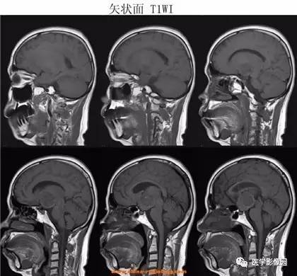 【病例】鞍区颗粒细胞瘤1例CT及MR影像表现 【病例】鞍区颗粒细胞瘤1例CT及MR影像表现