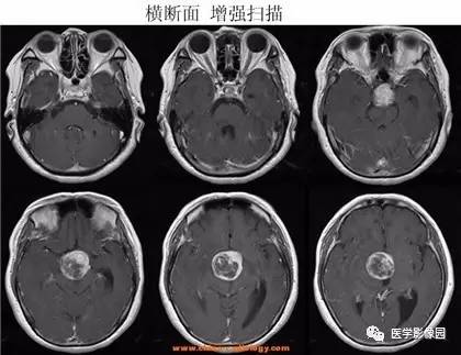 【病例】鞍区颗粒细胞瘤1例CT及MR影像表现 【病例】鞍区颗粒细胞瘤1例CT及MR影像表现