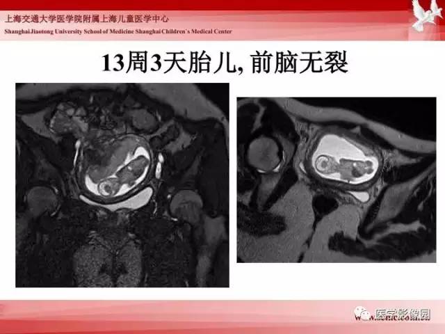 【PPT】胎儿神经系统MR检查规范与诊断思路