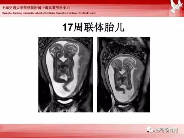 【PPT】胎儿神经系统MR检查规范与诊断思路