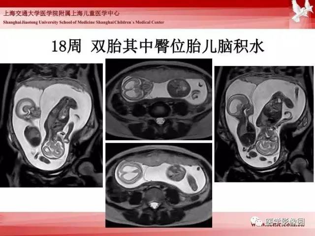 【PPT】胎儿神经系统MR检查规范与诊断思路