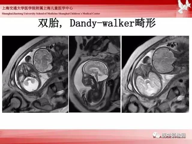 【PPT】胎儿神经系统MR检查规范与诊断思路