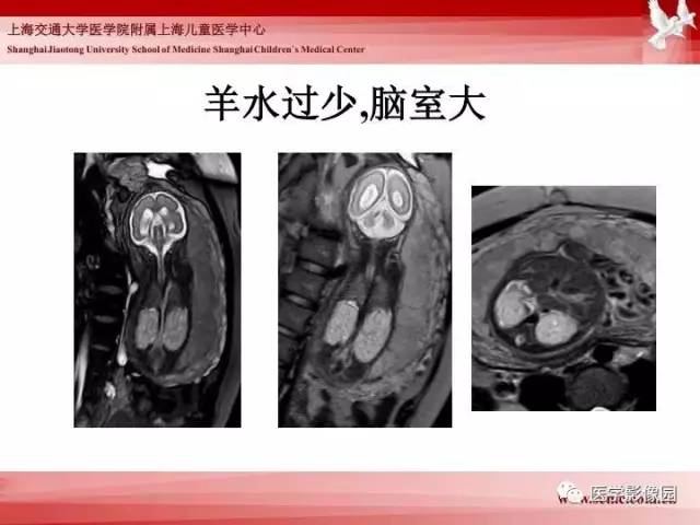 【PPT】胎儿神经系统MR检查规范与诊断思路
