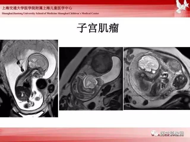 【PPT】胎儿神经系统MR检查规范与诊断思路