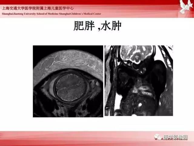 【PPT】胎儿神经系统MR检查规范与诊断思路