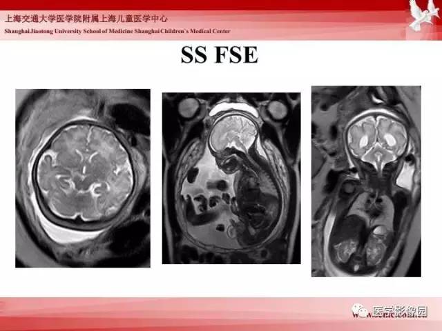 【PPT】胎儿神经系统MR检查规范与诊断思路