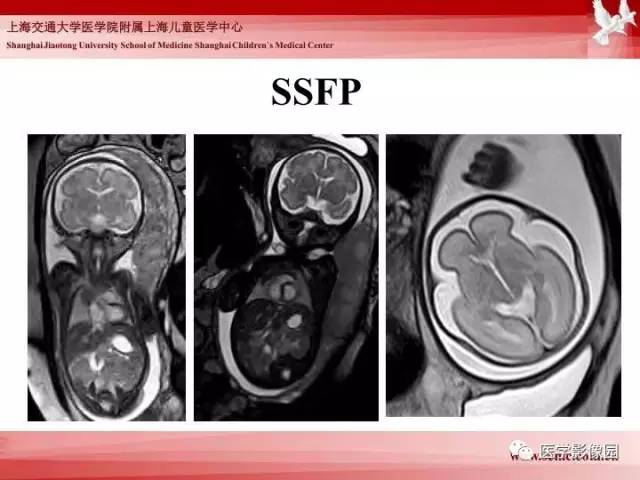 【PPT】胎儿神经系统MR检查规范与诊断思路