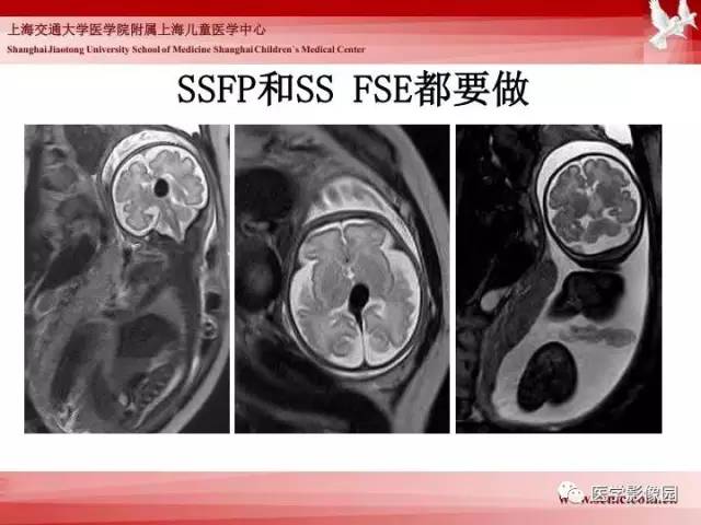 【PPT】胎儿神经系统MR检查规范与诊断思路