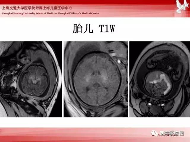 【PPT】胎儿神经系统MR检查规范与诊断思路