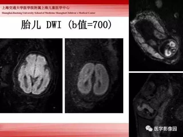 【PPT】胎儿神经系统MR检查规范与诊断思路