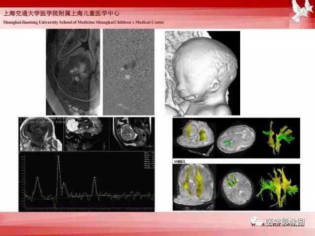 【PPT】胎儿神经系统MR检查规范与诊断思路