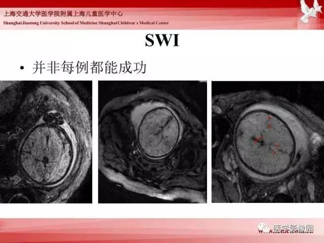 【PPT】胎儿神经系统MR检查规范与诊断思路