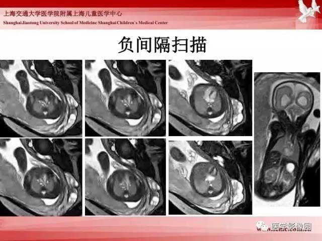 【PPT】胎儿神经系统MR检查规范与诊断思路