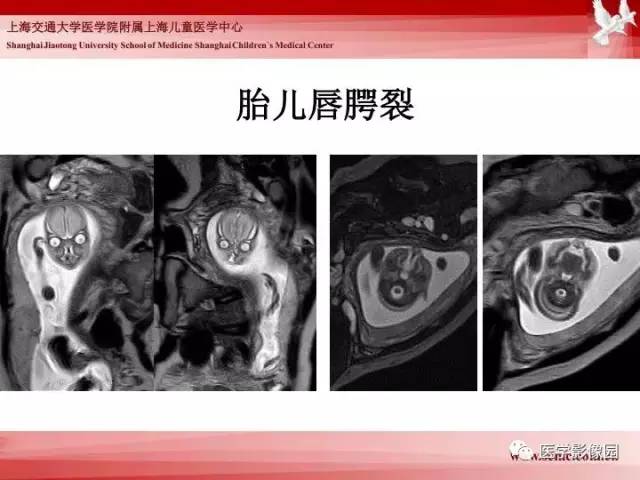 【PPT】胎儿神经系统MR检查规范与诊断思路