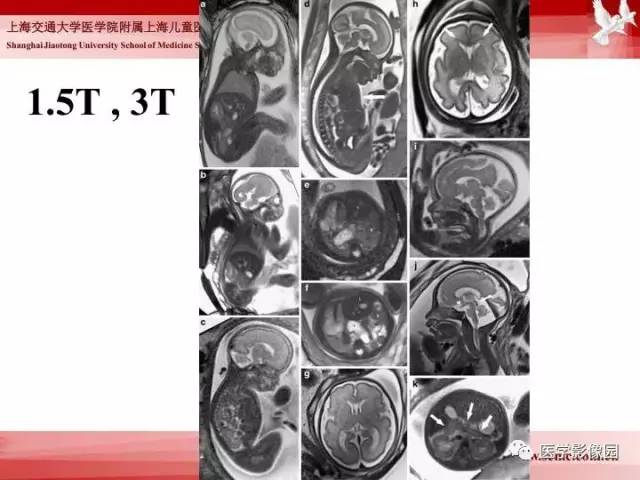 【PPT】胎儿神经系统MR检查规范与诊断思路