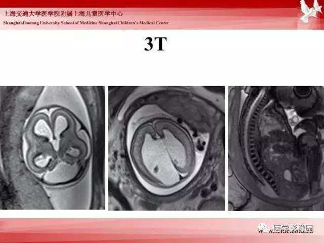 【PPT】胎儿神经系统MR检查规范与诊断思路