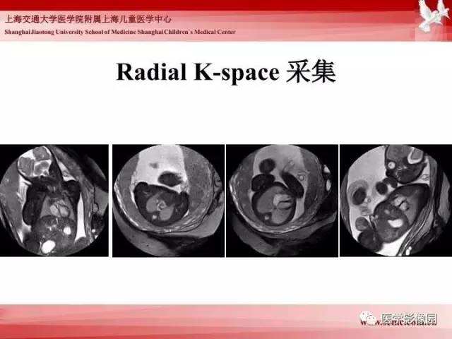 【PPT】胎儿神经系统MR检查规范与诊断思路