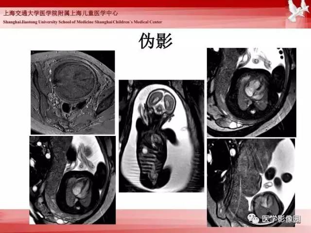 【PPT】胎儿神经系统MR检查规范与诊断思路