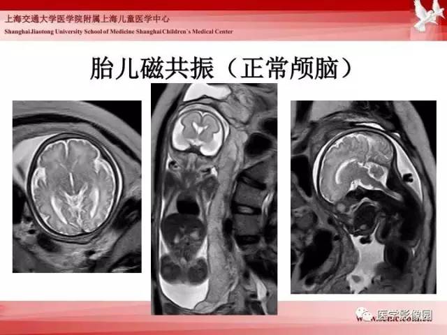 【PPT】胎儿神经系统MR检查规范与诊断思路