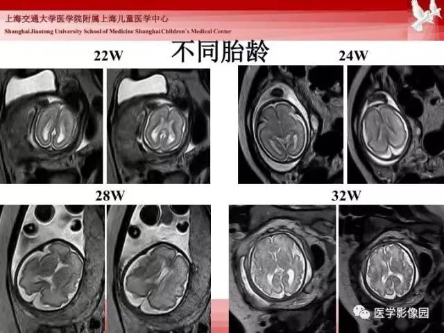 【PPT】胎儿神经系统MR检查规范与诊断思路