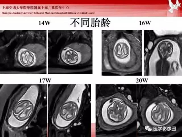 【PPT】胎儿神经系统MR检查规范与诊断思路