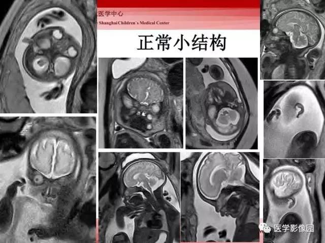 【PPT】胎儿神经系统MR检查规范与诊断思路